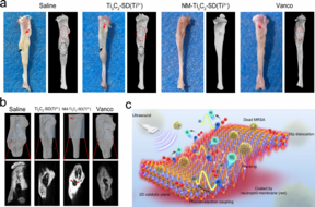 HKUMed creates a new two-dimensional (2D) responsive antibacterial nanosheet to effectively treat bone tissue infections.  University of Hong Kong CREDIT